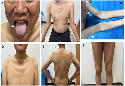 Case report: A patient with brachio-cervical inflammatory myopathy was misdiagnosed as flail arm syndrome